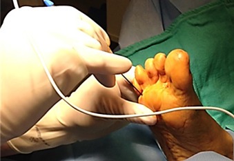 radiofrequency ablation neuroma 038fb6cfbc7143564c6aaec2b8895984